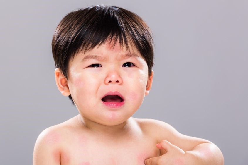 Dị ứng ở trẻ nhỏ có thể được gây ra bởi dị nguyên có sẵn trong cơ thể